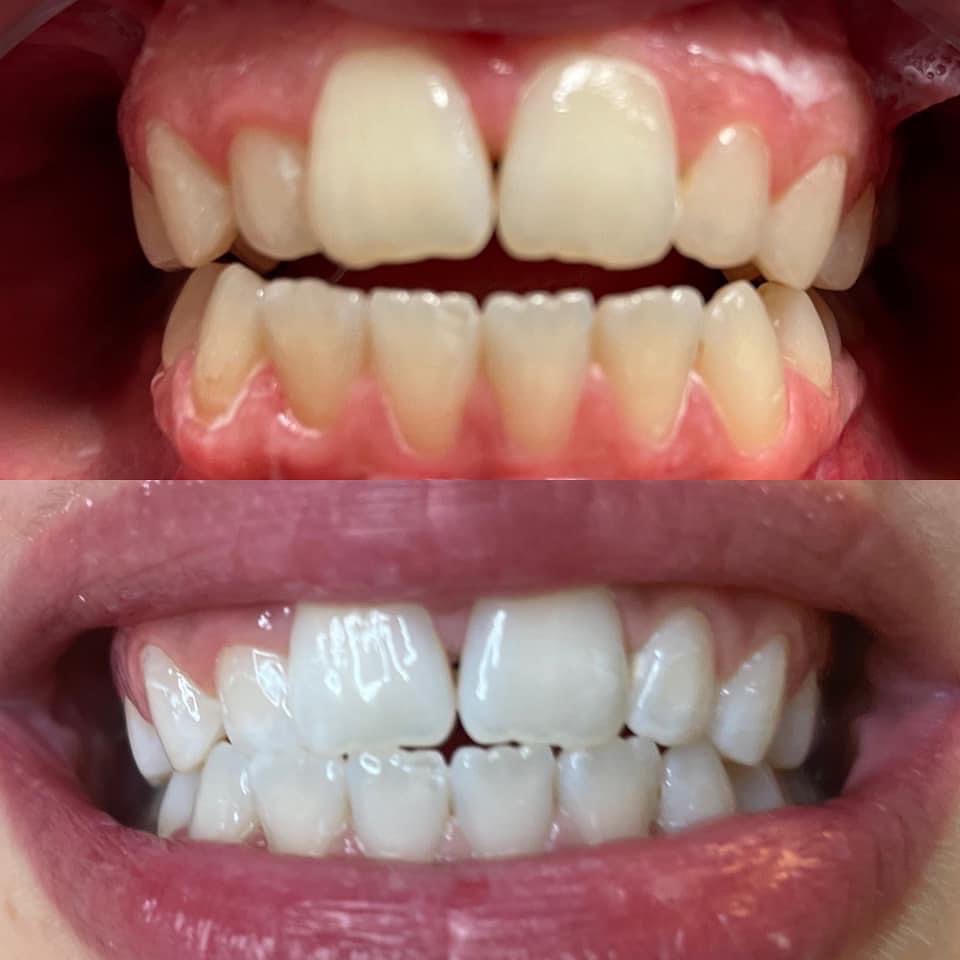 Teeth whitening at Victoria's Beauty & Nails